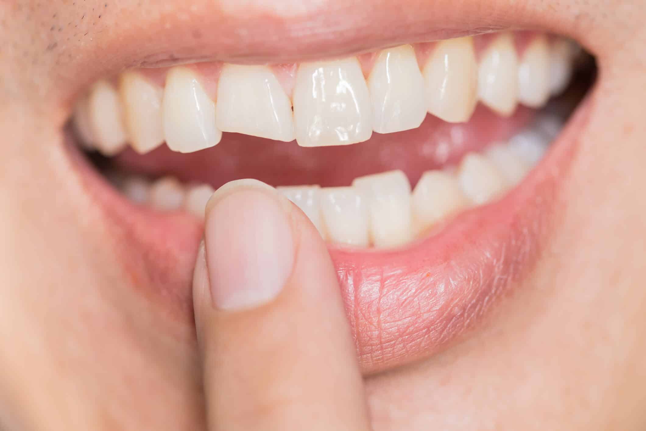 Dente quebrado