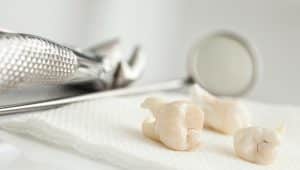 perda de dentes