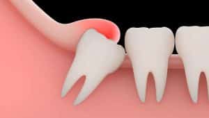 dente siso