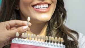 facetas dentarias