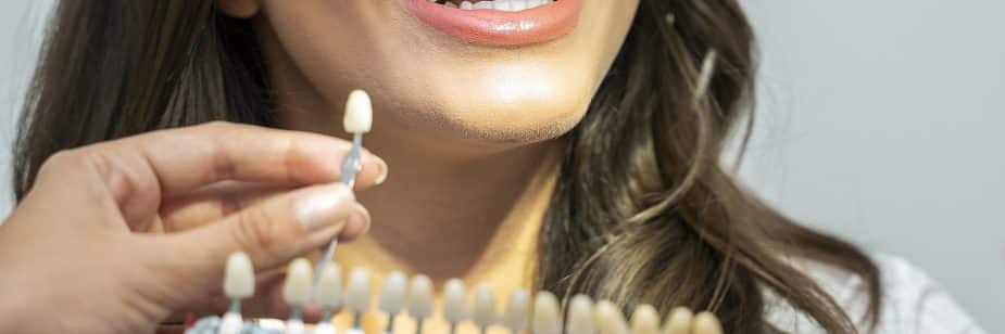 facetas dentarias